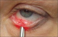 Лечението на ечемик на окото е възможно и ефективно с народни средства