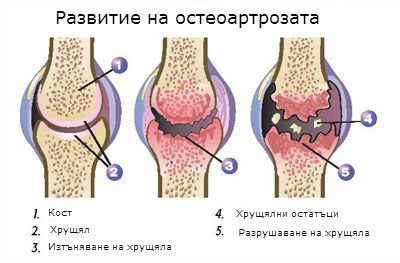 Staphylococcal_arthritis_and_polyarthritis