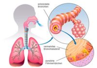 Хормоните могат да подобрят белодробната функция и астмата