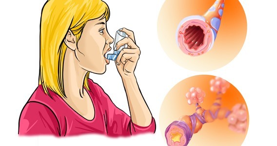 Този тест ще покаже дали страдате от астма