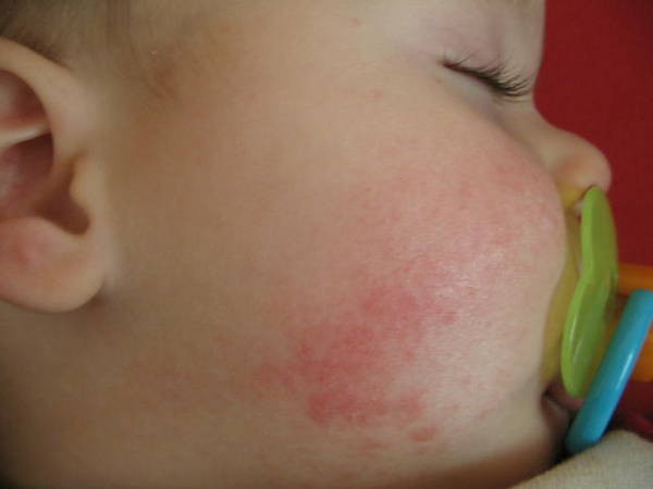 Най-често от атопичен дерматит страдат малките деца