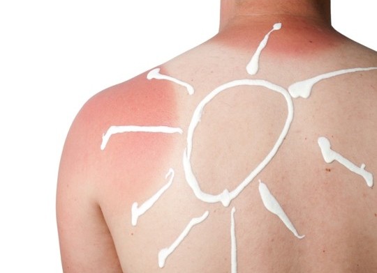 Вземете превантивни мерки срещу опасното слънчево изгаряне 