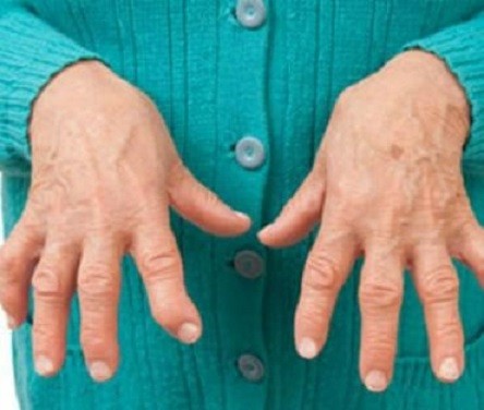 ревматоиден артрит болка