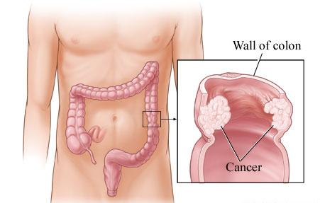 Какво представлява ракът на дебелото черво
