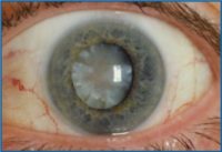 катаракта на окото