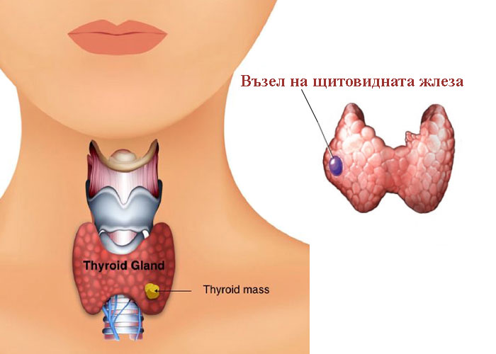 заболявания на щитовидната жлеза
