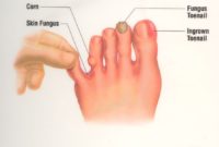 Gabichni infekcii pod noktite 4