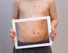 ipad причини алергия на 11-годишно дете