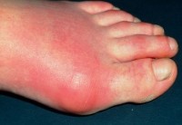 Gout. Close-up of the foot of a patient with gout, showing an inflamed, reddened area around the joint at the base of the big toe. Gout is a type of arthritis (joint disease) caused by an excess- ive level of the waste product uric acid in the blood stream. Crystals of uric acid collect inside the fluid-filled space within a joint (often just in the toe joint, as in this case) causing inflam- mation & acute pain. Gout is sometimes associated with kidney disorders, such as kidney stones, and is far more common in men than women. Treatment includes anti-inflammatory drugs and drugs to lower the level of uric acid in the blood. Attacks of gout usually subside after a few days.