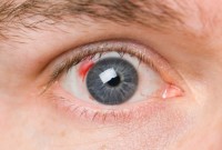 Диабетът предизвиква ретинопатия