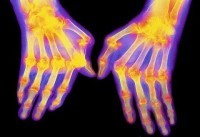 Болката от ревматоидния артрит почти никога не стихва напълно