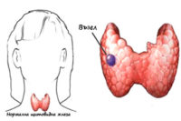 Възлите на щитовидната жлеза могат да бъдат установени от ендокринолог