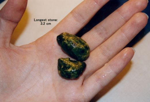 Можете да предотвратите появата на жлъчни камъни