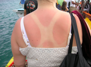Слънчевите изгаряния увеличават риска от рак на кожата: доказано!