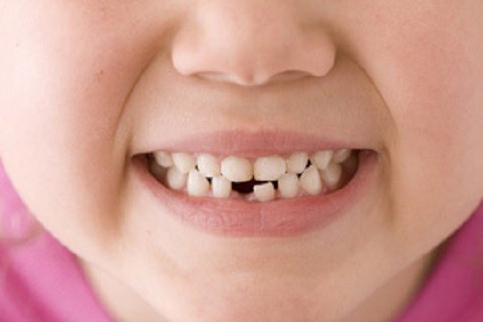 При никнене на млечни зъби някои деца стават раздразнителни 