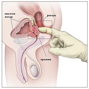 Лечение на рак на простатата 