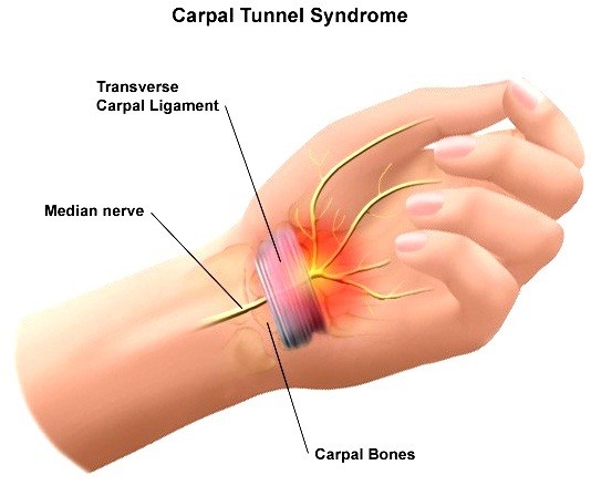 Carpal-Tunnel-Syndrome1