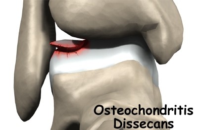 dissecans-osteochondritis