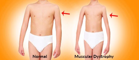 muscular-dystrophy