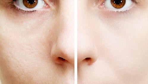 Woman with spotty skin with deep pores  and healed soft skin