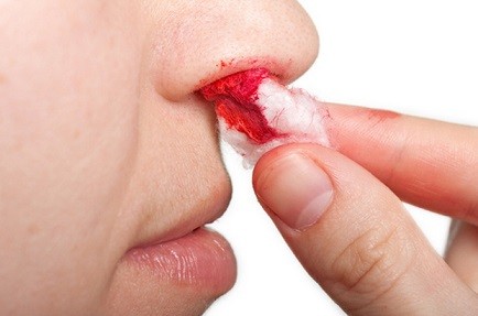кървене от носа