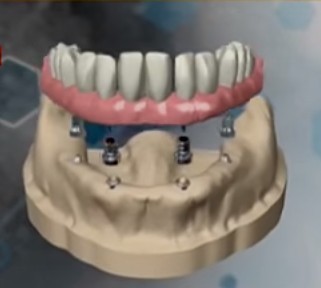 стоматологията 