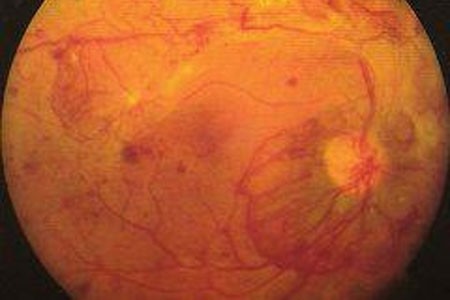 диабетна ретинопатия