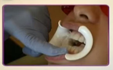 избелване на зъбите 