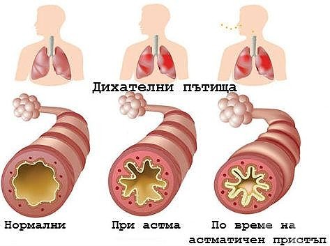 астма лечение