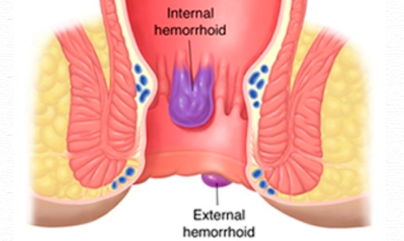 Хемороидите - вътрешни и външни