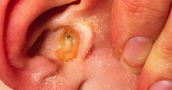 инфекцията в ухото