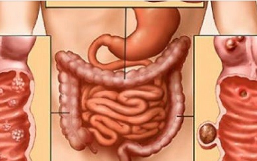 ракът на дебелото черво