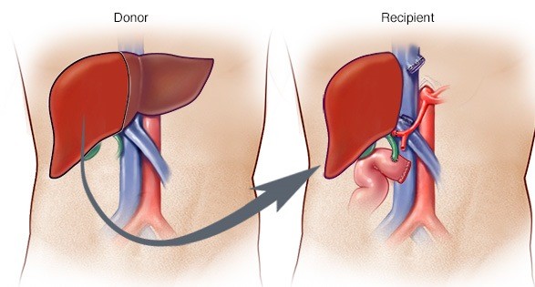 Трансплантация на черен дроб