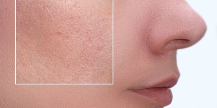 разширените пори