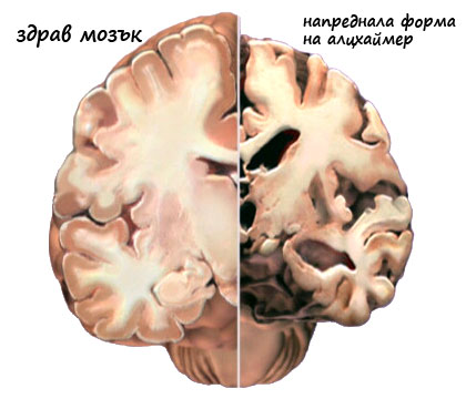 болестта на алцхаймер
