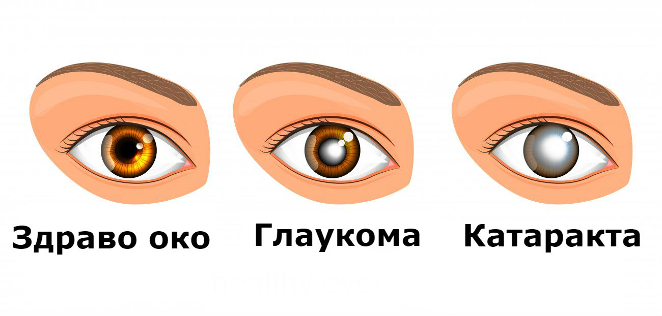 Можно вернуть зрение при глаукоме. Глаза катаракта глаукома. Здоровые глаза. Катаракта и здоровый глаз.