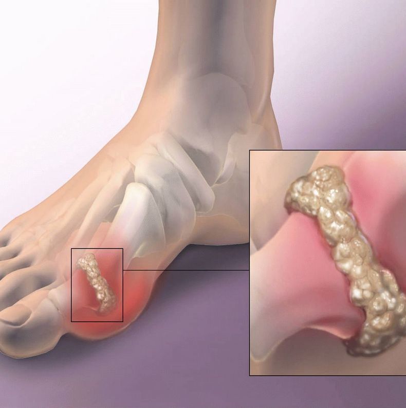 натрупване на пикочна киселина