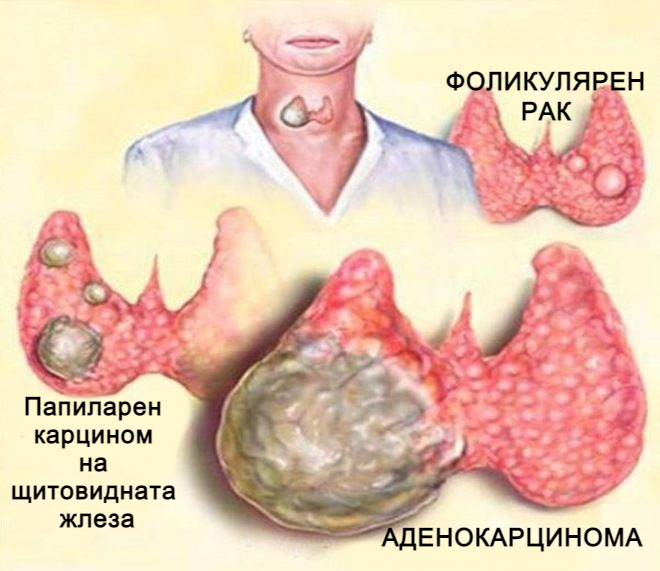 рак на щитовидната жлеза