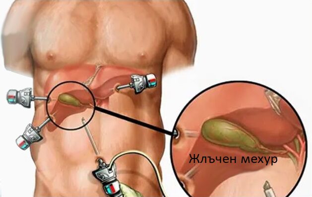 отстраняване на жлъчния мехур