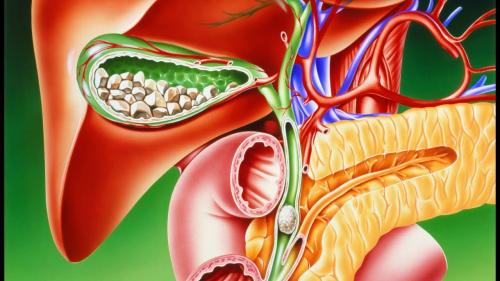 камъни в жлъчката