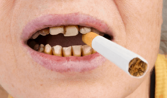 зъбите на пушача