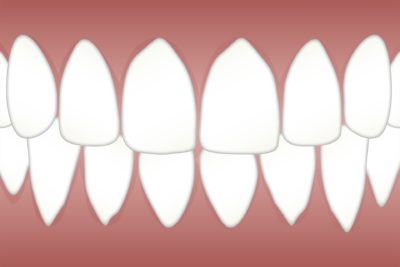 зъби и остеопороза