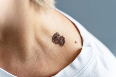 5 признака на рак на кожата