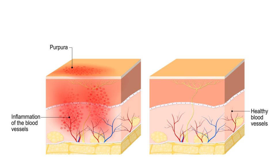 кожен васкулит