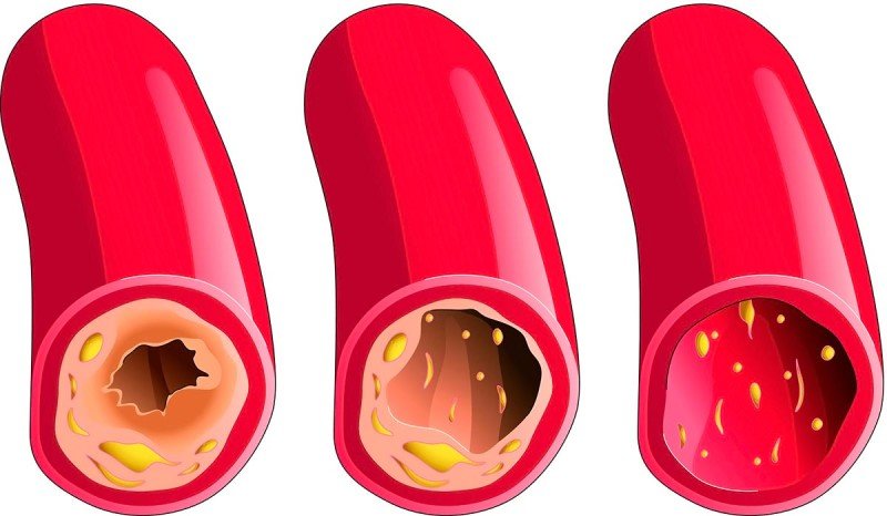 васкулит причини