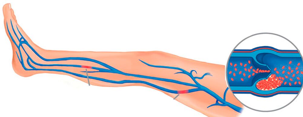 плаващ тромб