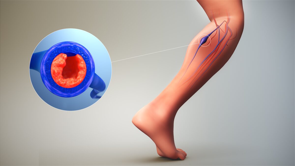 плаващ тромб