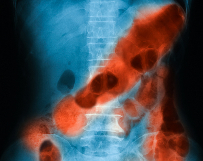 мезентериална тромбоза