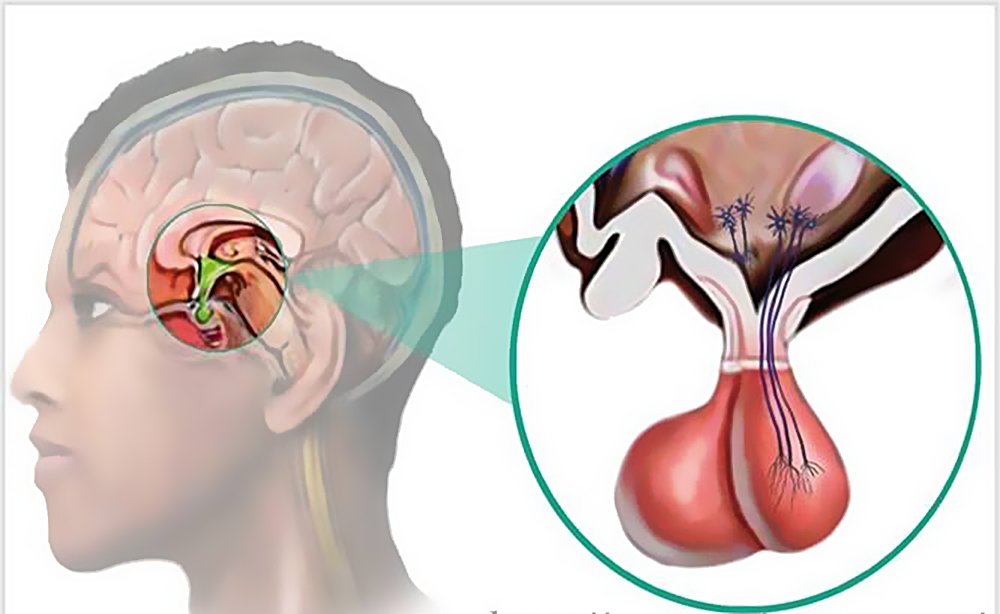 Аденом на хипофизата симптоми и лечение аденом на хипофизата