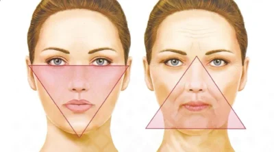 увиснала кожа